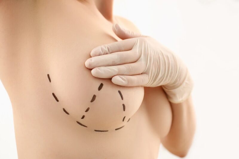 Efekty uboczne po powiększeniu piersi